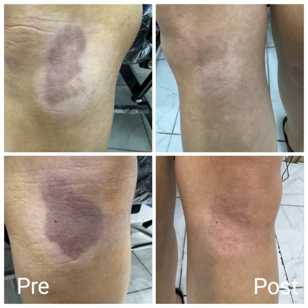Get rid of knee pigmentation after just one session
